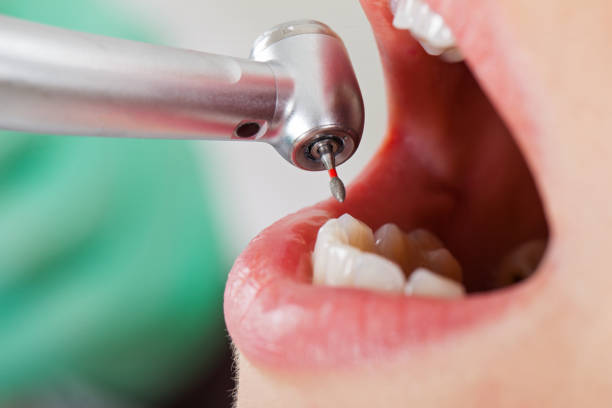 Best Emergency Dental Care for Broken or Chipped Teeth in Wilton Center, CT